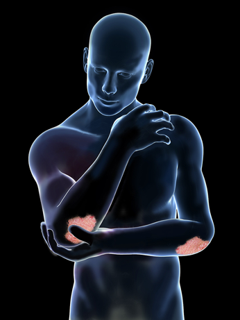 Psoriasis Plaque Psoriasis