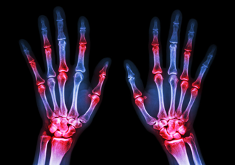 Rheumatoid Arthritis Rheumatoid Arthritis