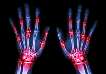 Rheumatoid Arthritis